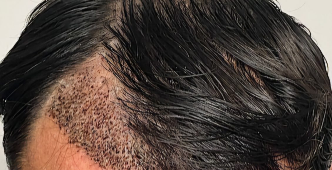 زراعة الشعر بدون حلاقة